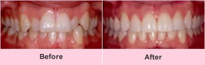Orthodontics before and after